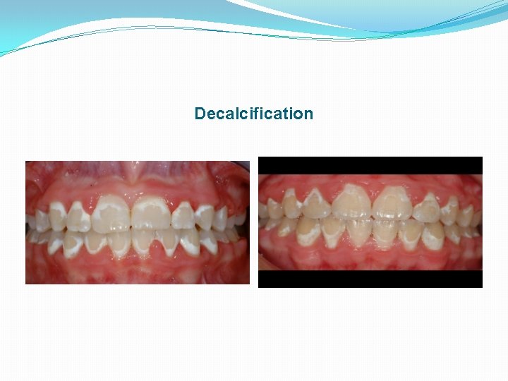 Decalcification 