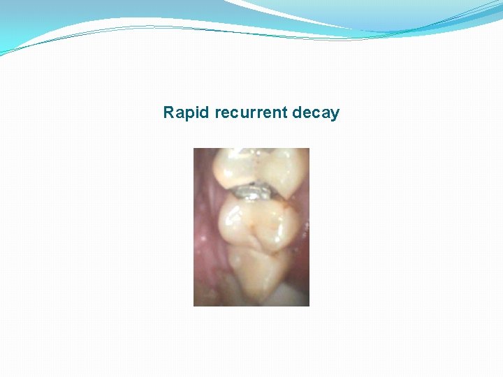 Rapid recurrent decay 