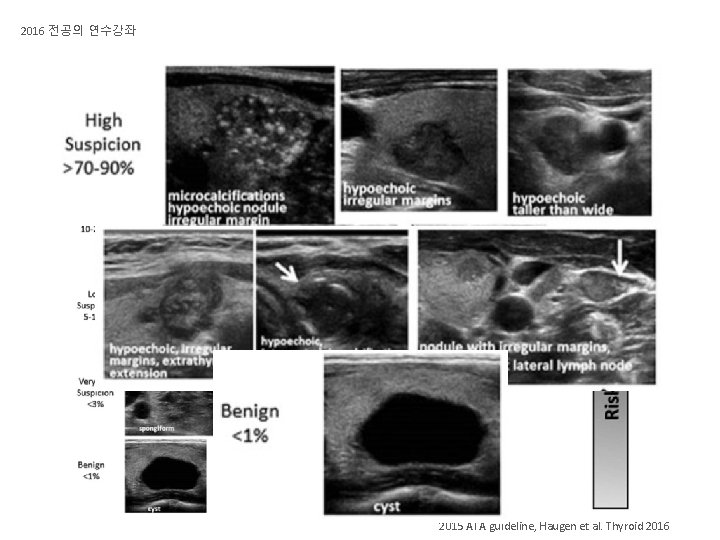 2016 전공의 연수강좌 갑상선 결절의 초음파 소견 2015 ATA guideline, Haugen et al. Thyroid