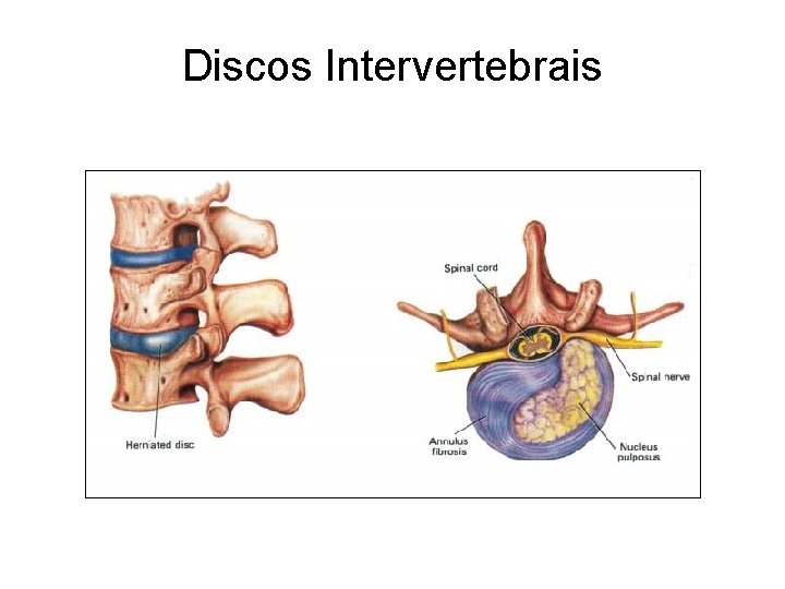 Discos Intervertebrais 