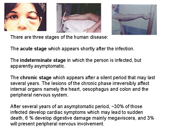 There are three stages of the human disease: The acute stage which appears shortly