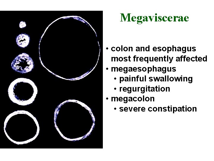 Megaviscerae • colon and esophagus most frequently affected • megaesophagus • painful swallowing •