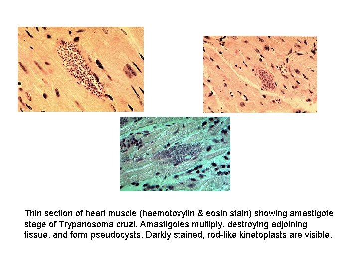 Thin section of heart muscle (haemotoxylin & eosin stain) showing amastigote stage of Trypanosoma