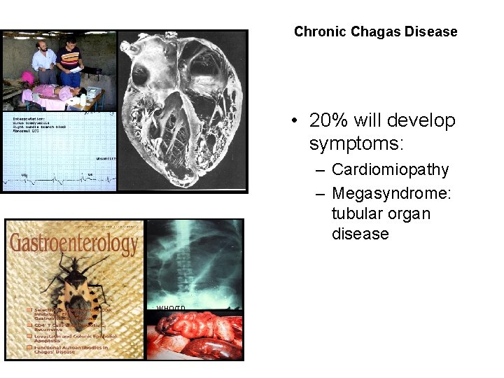 Chronic Chagas Disease • 20% will develop symptoms: – Cardiomiopathy – Megasyndrome: tubular organ