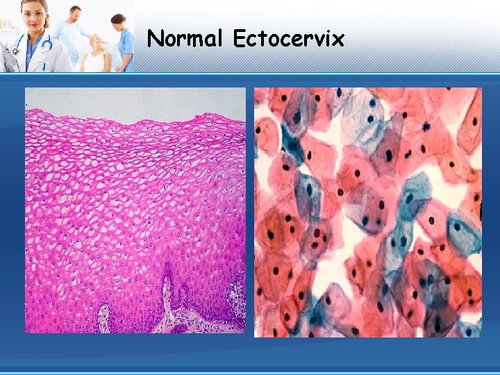 Normal Ectocervix 