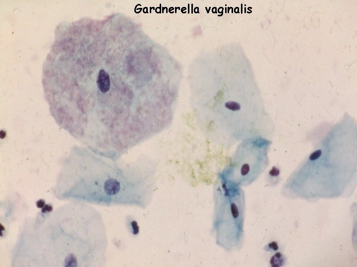 Gardnerella vaginalis 