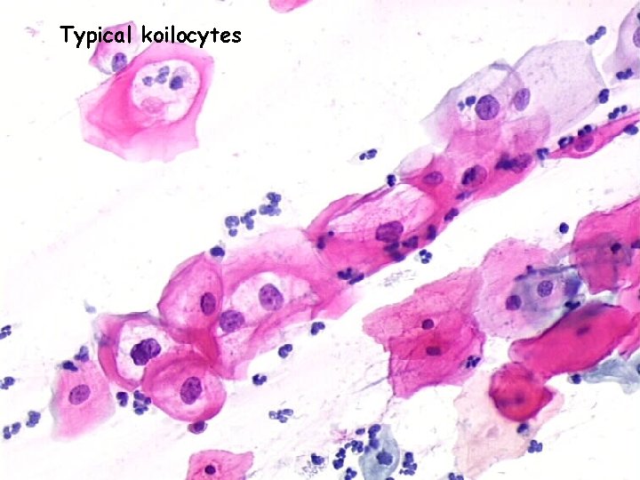Typical koilocytes 
