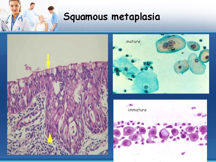 Squamous metaplasia mature immature 