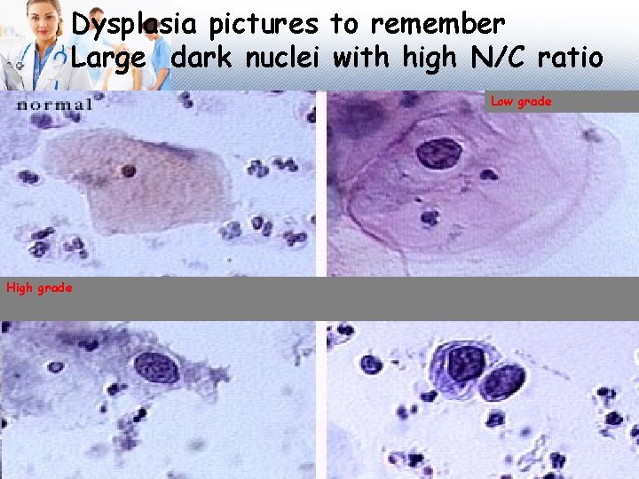 Dysplasia pictures to remember Large dark nuclei with high N/C ratio Low grade High
