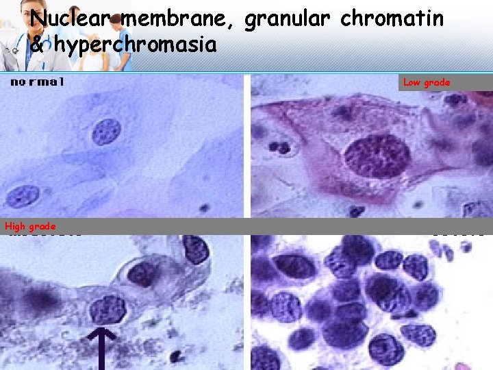 Nuclear membrane, granular chromatin & hyperchromasia Low grade High grade 
