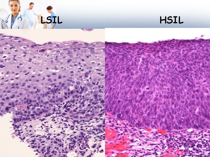 LSIL HSIL 