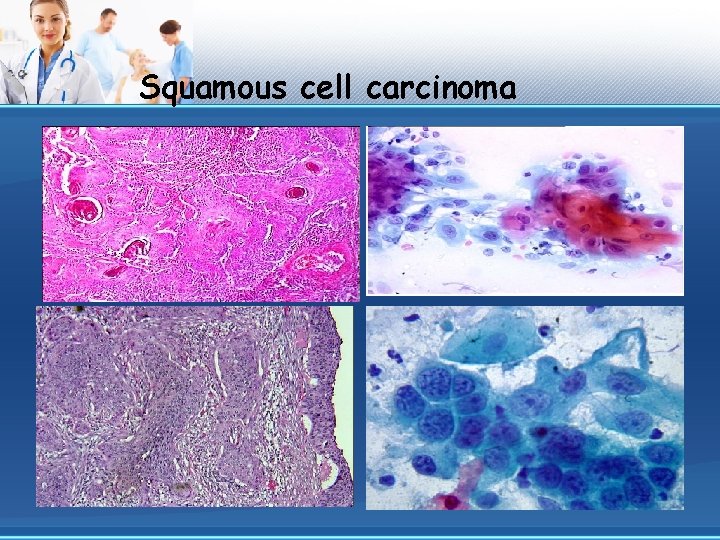 Squamous cell carcinoma 