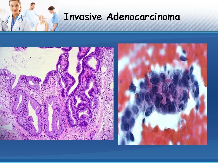 Invasive Adenocarcinoma 