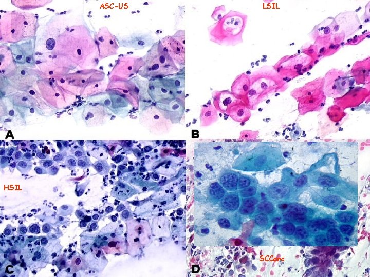 ASC-US LSIL HSIL SCCarc 