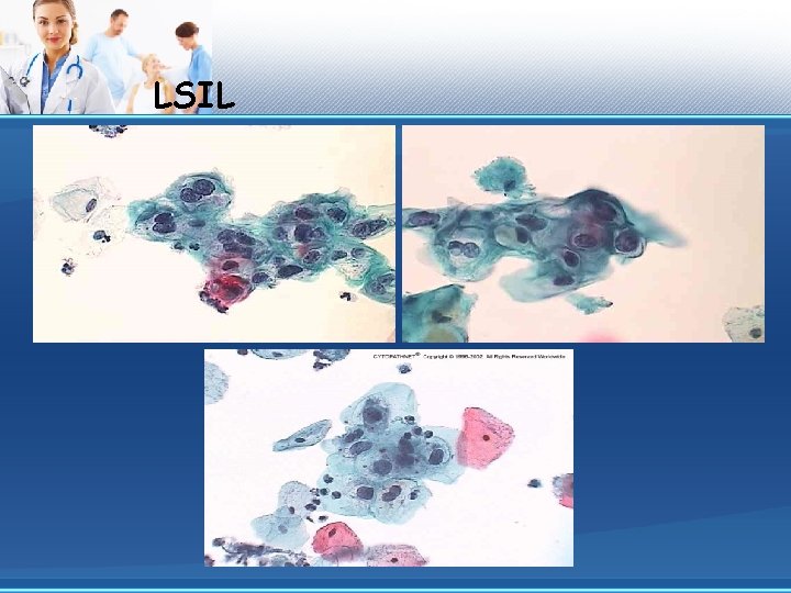 LSIL 