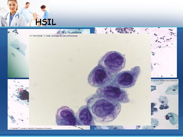 HSIL 