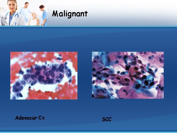 Malignant Adenocar Cx SCC 