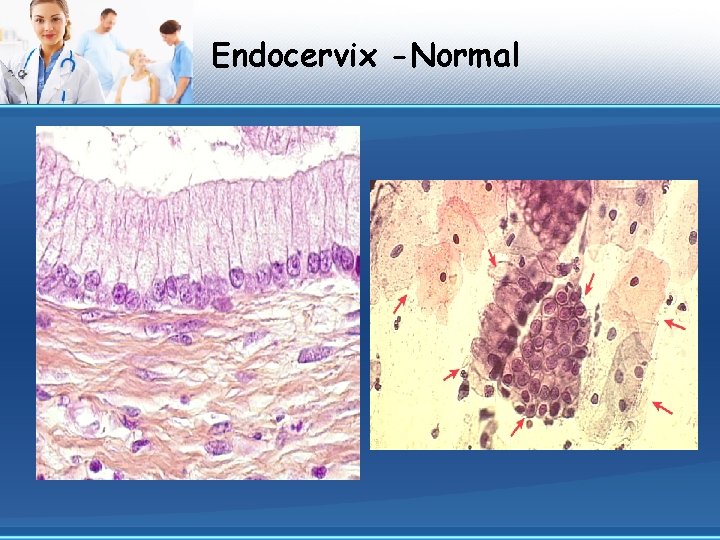 Endocervix -Normal 