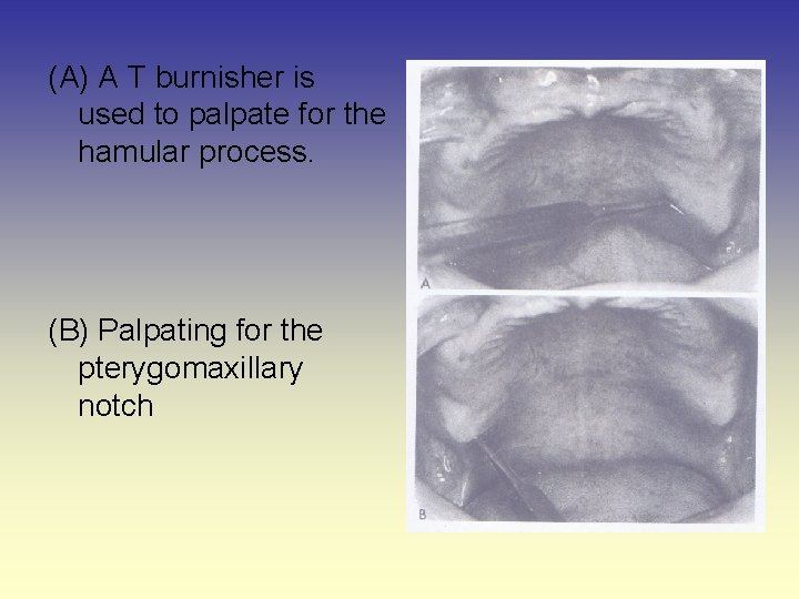 (A) A T burnisher is used to palpate for the hamular process. (B) Palpating