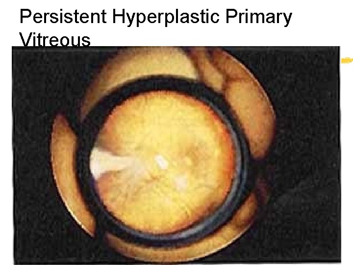 Persistent Hyperplastic Primary Vitreous 