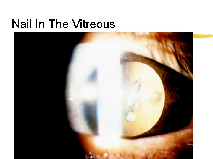 Nail In The Vitreous 