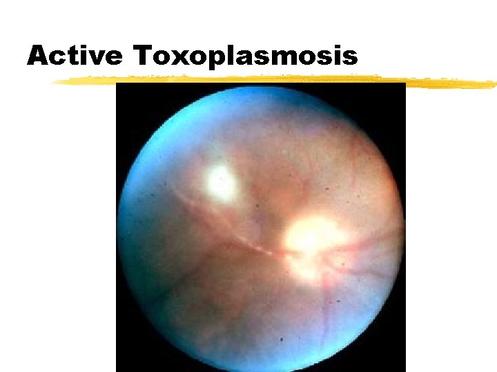 Active Toxoplasmosis 