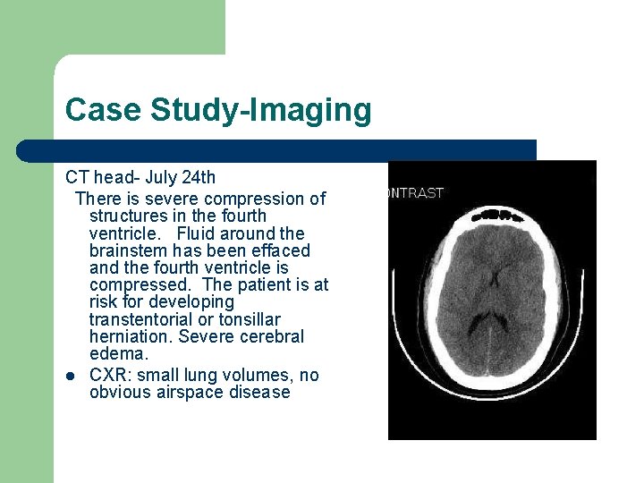 Case Study-Imaging CT head- July 24 th There is severe compression of structures in