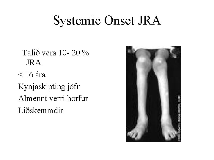 Systemic Onset JRA Talið vera 10 - 20 % JRA < 16 ára Kynjaskipting