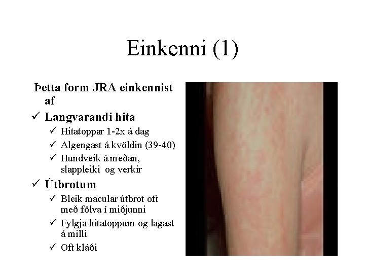 Einkenni (1) Þetta form JRA einkennist af ü Langvarandi hita ü Hitatoppar 1 -2