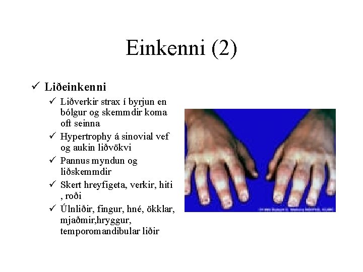 Einkenni (2) ü Liðeinkenni ü Liðverkir strax í byrjun en bólgur og skemmdir koma
