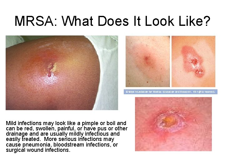 MRSA: What Does It Look Like? Mild infections may look like a pimple or