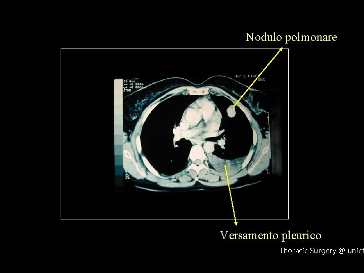 Nodulo polmonare Versamento pleurico Thoracic Surgery @ unict 