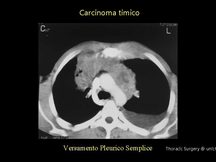 Carcinoma timico Versamento Pleurico Semplice Thoracic Surgery @ unict 