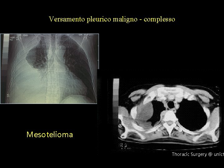 Versamento pleurico maligno - complesso Mesotelioma Thoracic Surgery @ unict 