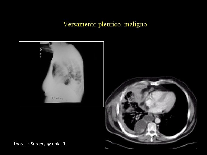 Versamento pleurico maligno Thoracic Surgery @ unict. it 