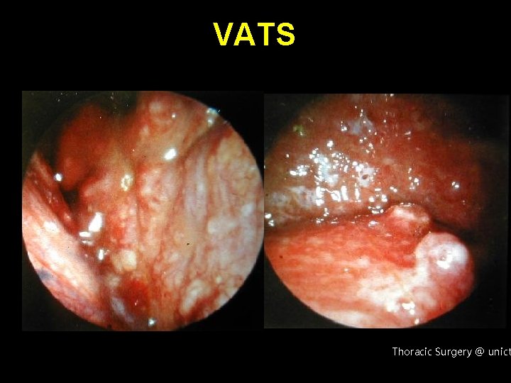 VATS Thoracic Surgery @ unict 