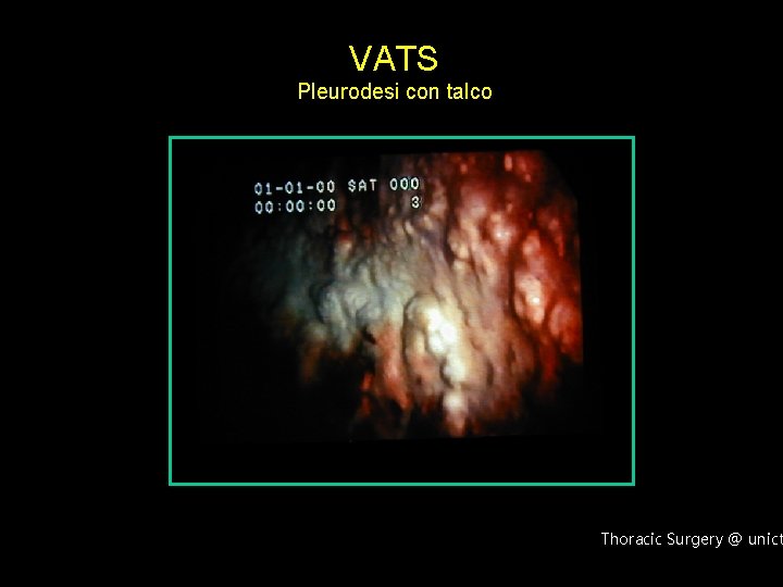 VATS Pleurodesi con talco Thoracic Surgery @ unict 