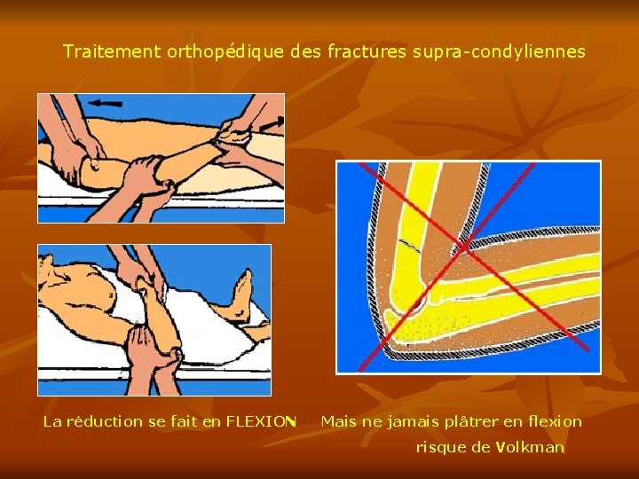 Traitement orthopédique des fractures supra-condyliennes La réduction se fait en FLEXION Mais ne jamais