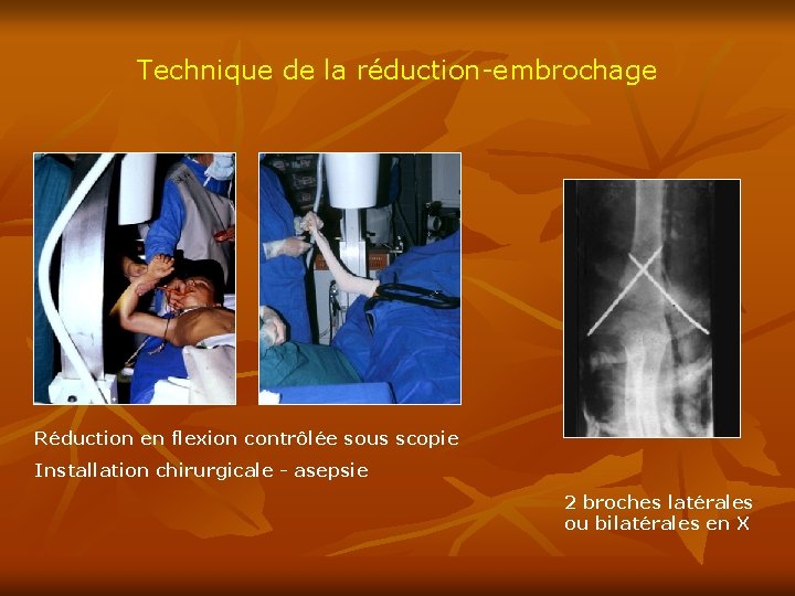 Technique de la réduction-embrochage Réduction en flexion contrôlée sous scopie Installation chirurgicale - asepsie