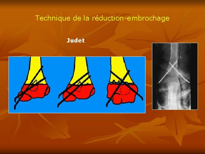 Technique de la réduction-embrochage Judet 