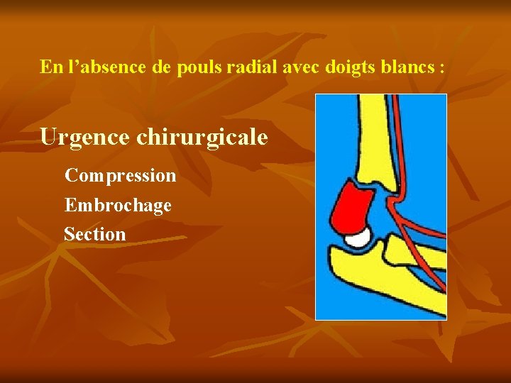 En l’absence de pouls radial avec doigts blancs : Urgence chirurgicale Compression Embrochage Section