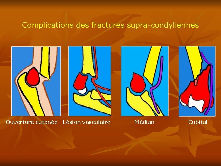 Complications des fractures supra-condyliennes Ouverture cutanée Lésion vasculaire Médian Cubital 