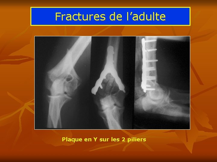 Fractures de l’adulte Plaque en Y sur les 2 piliers 