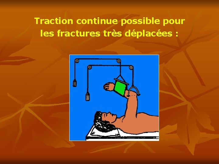 Traction continue possible pour les fractures très déplacées : 