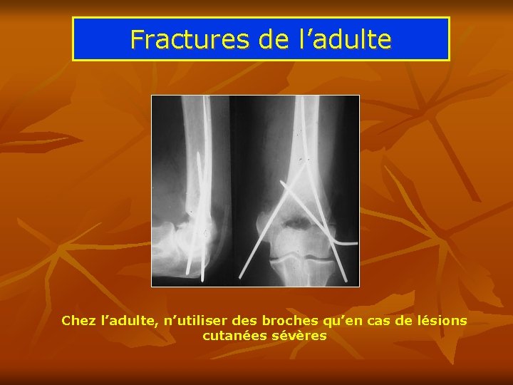 Fractures de l’adulte Chez l’adulte, n’utiliser des broches qu’en cas de lésions cutanées sévères