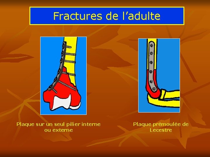 Fractures de l’adulte Plaque sur un seul pilier interne ou externe Plaque prémoulée de