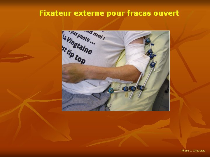 Fixateur externe pour fracas ouvert Photo J. Chouteau 