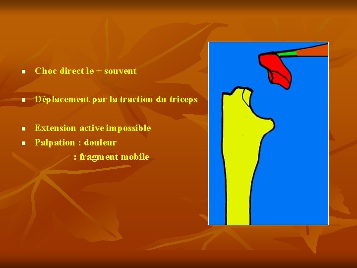 n Choc direct le + souvent n Déplacement par la traction du triceps Extension