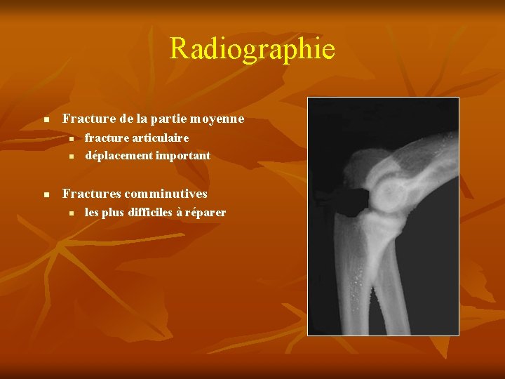 Radiographie n Fracture de la partie moyenne n n n fracture articulaire déplacement important