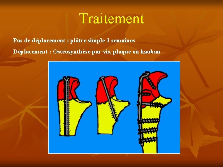 Traitement Pas de déplacement : plâtre simple 3 semaines Déplacement : Ostéosynthèse par vis,